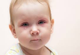 عفونت چشم در نوزاد شرکت خدماتی شکوفایی