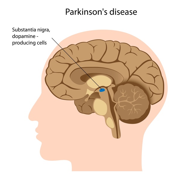 بیماری پارکینسون چیست؟