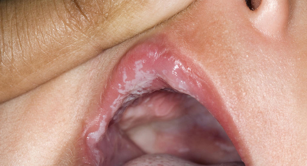 برفک دهان نوازد یک عفونت شایع مخمر دهانی است که باعث ایجاد لکه های سفید در دهان نوازد می شود 