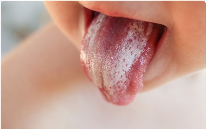 در صورت تشخیص برفک دهان نوازد یا برفک سینه مادر؛ شیردهی نباید قطع شود
