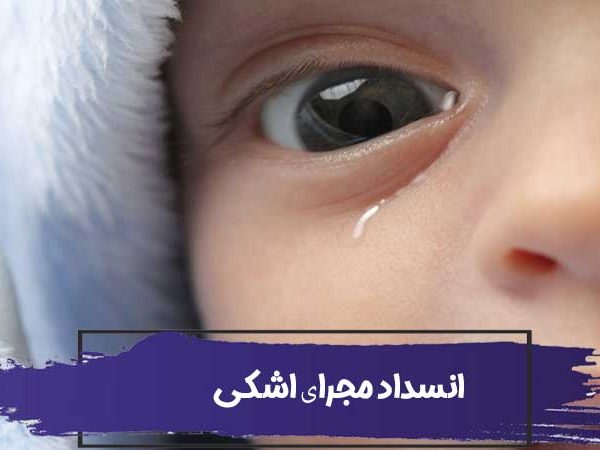 انسداد مجرای اشکی در نوزادان و بزرگسالان 1 انسداد مجرای اشکی در نوزادان و بزرگسالان