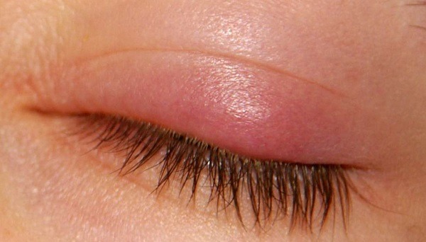 التهاب پلک چیست؟ آشنایی با انواع التهاب پلک چشم