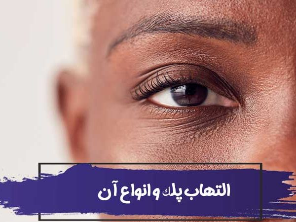 التهاب پلک چیست؟ آشنایی با انواع التهاب پلک چشم 2 التهاب پلک چیست؟ آشنایی با انواع التهاب پلک چشم
