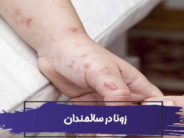 پرستاری از سالمندان - بیماری زونا در سالمندان چیست؟ 3 پرستاری از سالمندان تمام آنچه که باید در مورد بیماری زونا در سالمندان بدانید!