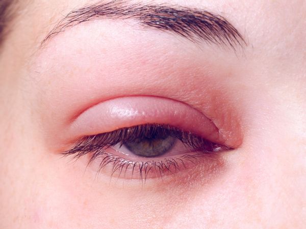 التهاب پلک چیست؟ آشنایی با انواع التهاب پلک چشم
