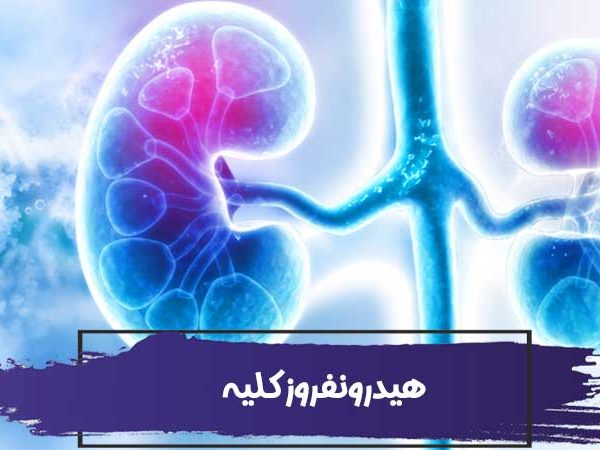 هیدرونفروز چیست؟ آیا هیدرونفروز کلیه خطرناک است؟ 3 هیدرونفروز چیست؟ آیا هیدرونفروز کلیه خطرناک است؟