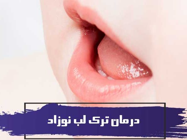 درمان ترک لب نوزاد 3 درمان ترک لب نوزاد