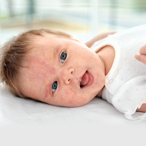 حساسیت نوزاد به شیر