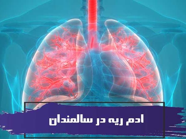 ادم ریه در سالمندان 2 Pulmonary oedema 1 600x450