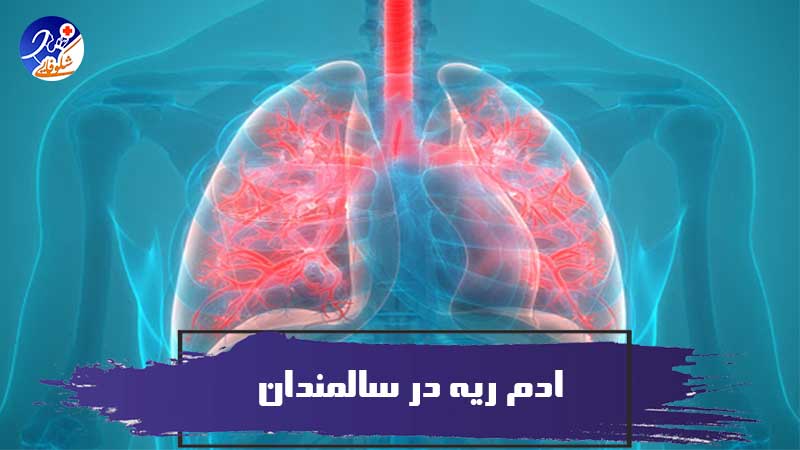 pulmonary oedema 1