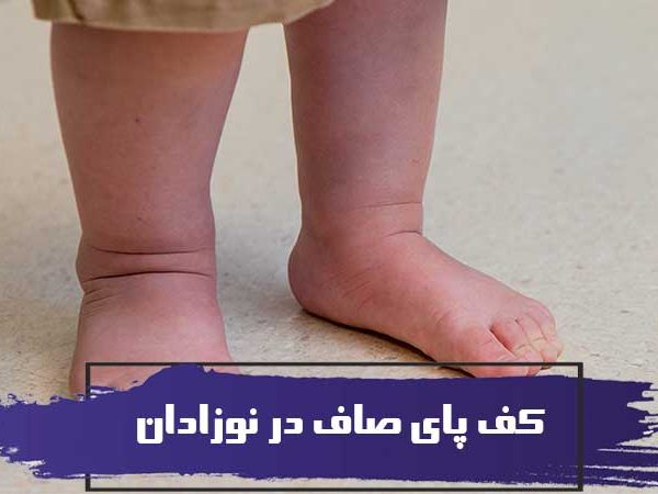 کف پای صاف در نوزادان 1 کف پای صاف در نوزادان