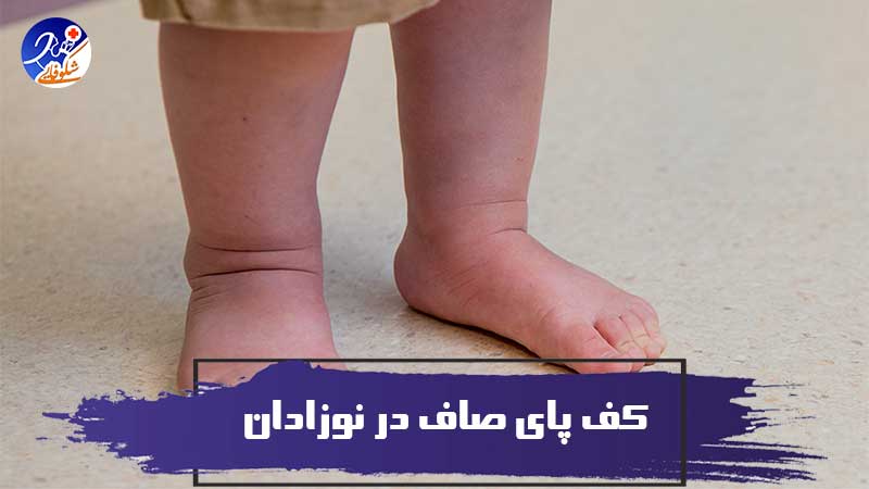 کف پای صاف در نوزادان