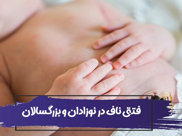 هر آنچه که باید در مورد فتق بدانید: انواع، علائم؛ علت، تشخیص و درمان فتق ناف 1 Hernia 600x450