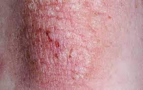درماتیت یا اگزما یکی از بیماری های رایج پوستی در سالمندان