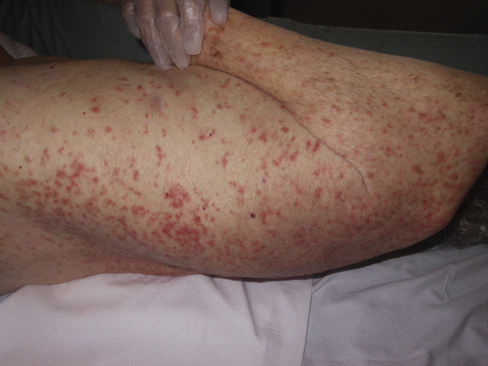 عفونت های پوستی سالمندان در خانه سالمندان