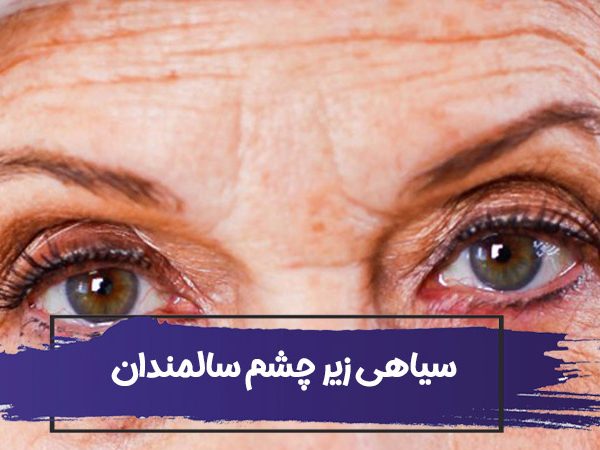 چه چیزی باعث سیاهی زیر چشم سالمندان می شود؟ 3 چه چیزی باعث سیاهی زیر چشم سالمندان می شود؟