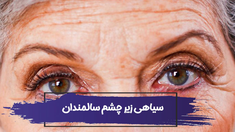 چه چیزی باعث سیاهی زیر چشم سالمندان می شود؟