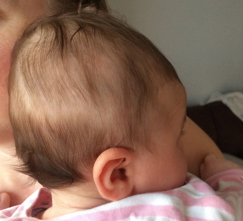 آیا ریزش مو در نوزادان طبیعی است؟