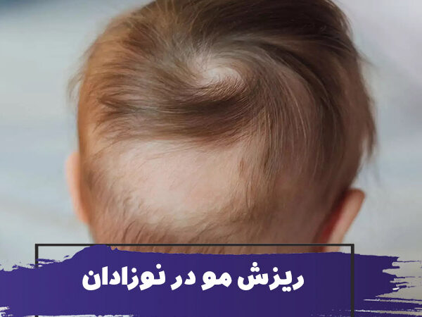 آیا ریزش مو در نوزادان طبیعی است؟ 1 Bald spot at baby head 600x450