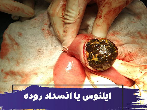 آیا سالمندان بیشتر در معرض خطر ابتلا به ایلئوس قرار دارند؟ علل، تشخیص، درمان انسداد روده 1 آیا سالمندان بیشتر در معرض خطر ابتلا به ایلئوس قرار دارند؟ علل، تشخیص، درمان انسداد روده