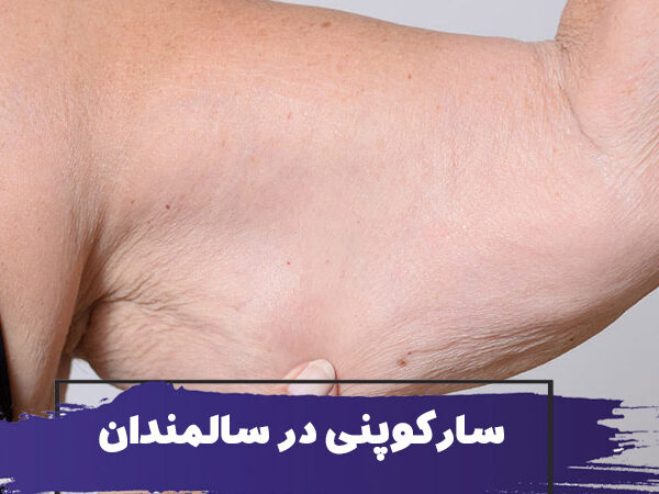 سارکوپنی در سالمندان : ورزش ها و مواد مغذی مبارزه با کاهش حجم عضلات 1 سارکوپنی در سالمندان : ورزش ها و مواد مغذی مبارزه با کاهش حجم عضلات