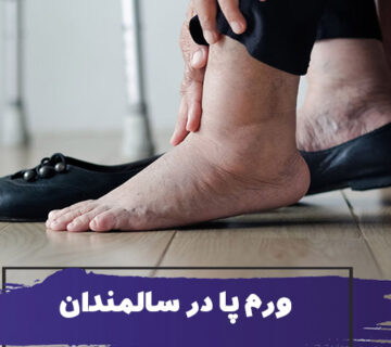 ورم پاها در سالمندان : علت ادم اندام تحتانی و کارهایی که باید انجام دهید