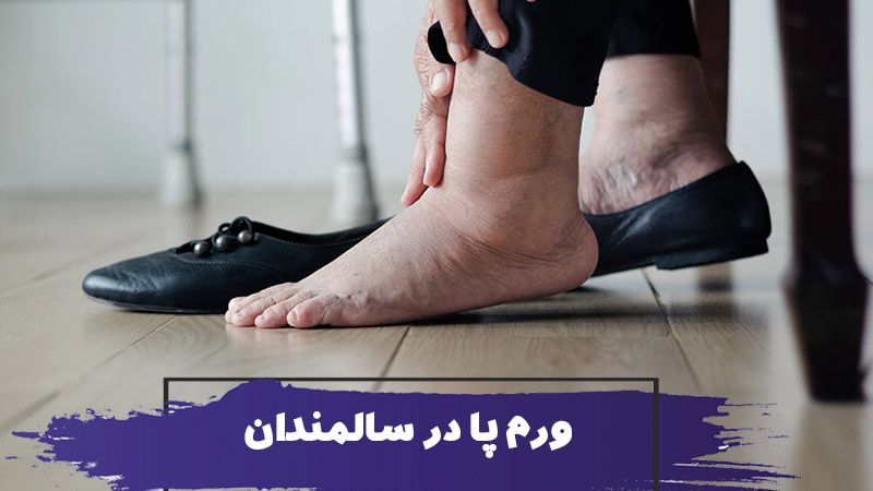 ورم پاها در سالمندان : علت ادم اندام تحتانی و کارهایی که باید انجام دهید