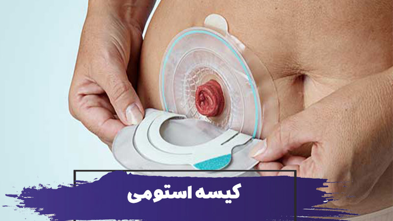 همه چیز درباره کیسه استومی برای سالمندان