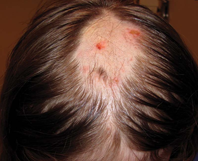 تریکوتیلومانیا چیست؟ علت و درمان اختلال کشیدن مو در کودکان