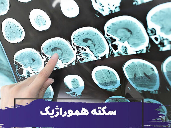 سکته هموراژیک چیست؟ انواع، علائم و درمان سکته مغزی هموراژیک در سالمندان 1 سکته هموراژیک چیست؟ انواع، علائم و درمان سکته مغزی هموراژیک در سالمندان