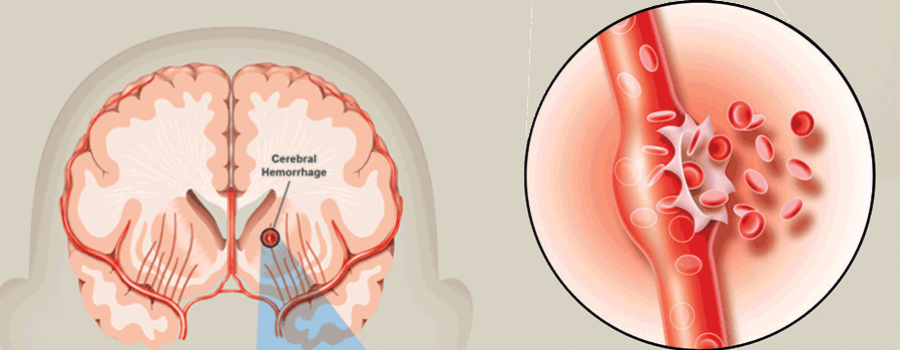 سکته هموراژیک چیست؟ انواع، علائم و درمان سکته مغزی هموراژیک در سالمندان