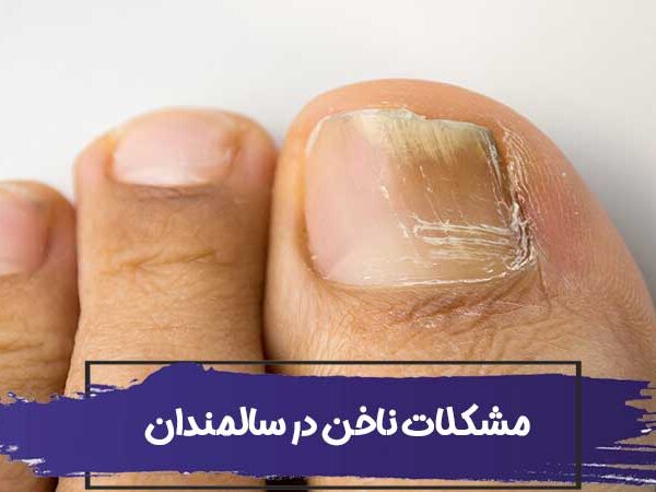 رایج ترین مشکلات ناخن در سالمندان 3 رایج ترین مشکلات ناخن در سالمندان