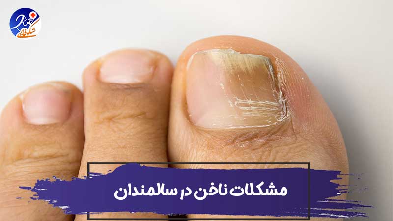 رایج ترین مشکلات ناخن در سالمندان 1 رایج ترین مشکلات ناخن در سالمندان