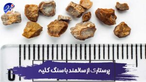 Kidney-Stones پرستاری و مراقبت از سالمند با سنگ کلیه